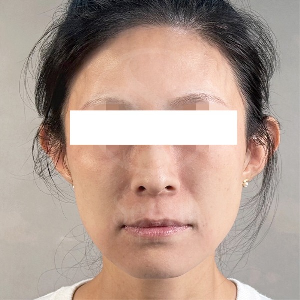 麗珠蘭-台版麗珠蘭療程前-首爾醫美