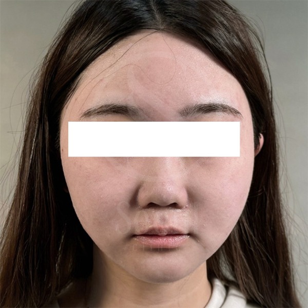 麗珠蘭-台版麗珠蘭療程前-首爾醫美