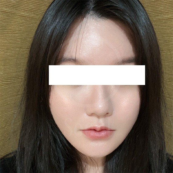 麗珠蘭-台版麗珠蘭術後2周-首爾醫美