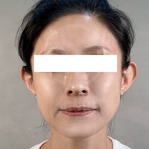 麗珠蘭-台版麗珠蘭術後2周-首爾醫美