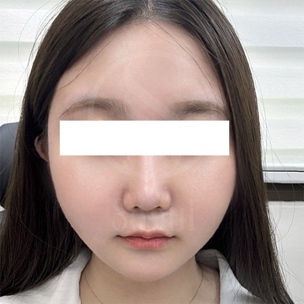 麗珠蘭-台版麗珠蘭術後2周-首爾醫美