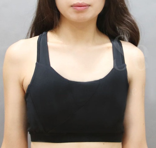 隆乳_隆乳手術Before_首爾醫美