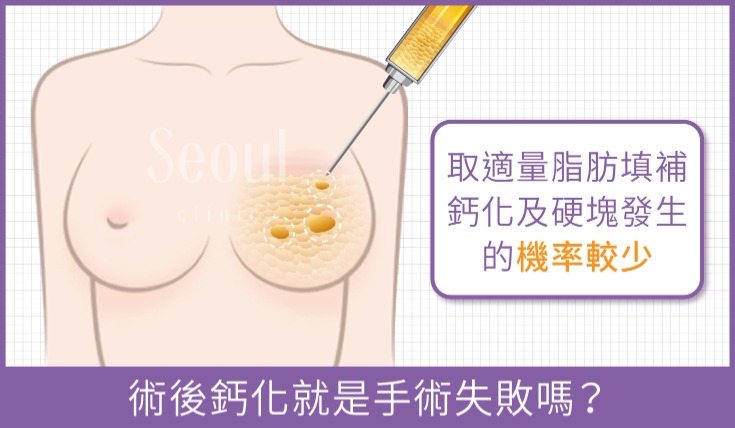 自體脂肪隆乳_術後鈣化就是手術失敗嗎？_首爾醫美