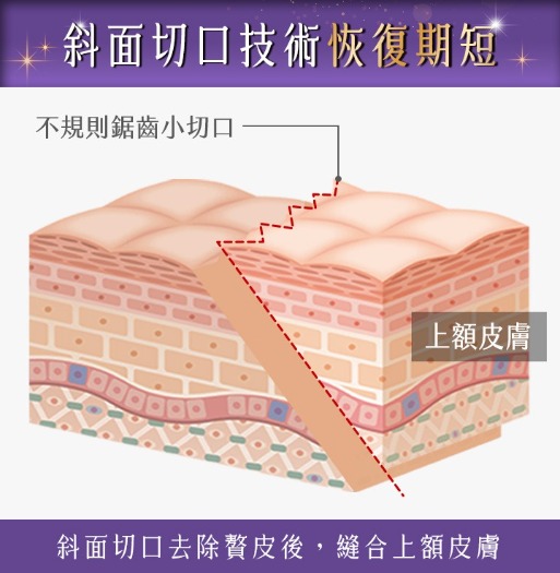 首爾醫美髮際線拉皮_斜面切口技術