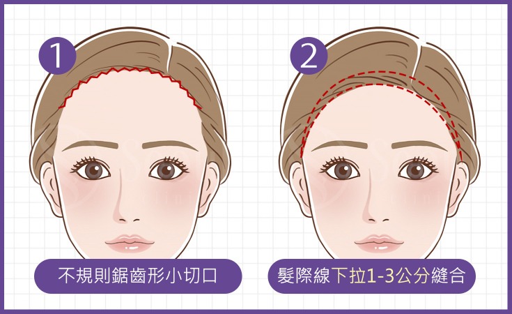 髮際線拉皮-「新式髮際線前移拉皮」是什麼？-首爾醫美診所