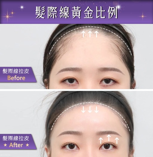 首爾醫美髮際線拉皮_找回髮際線黃金比例