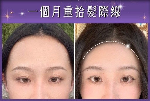 髮際線拉皮-一個月重新拾回髮際線-首爾醫美