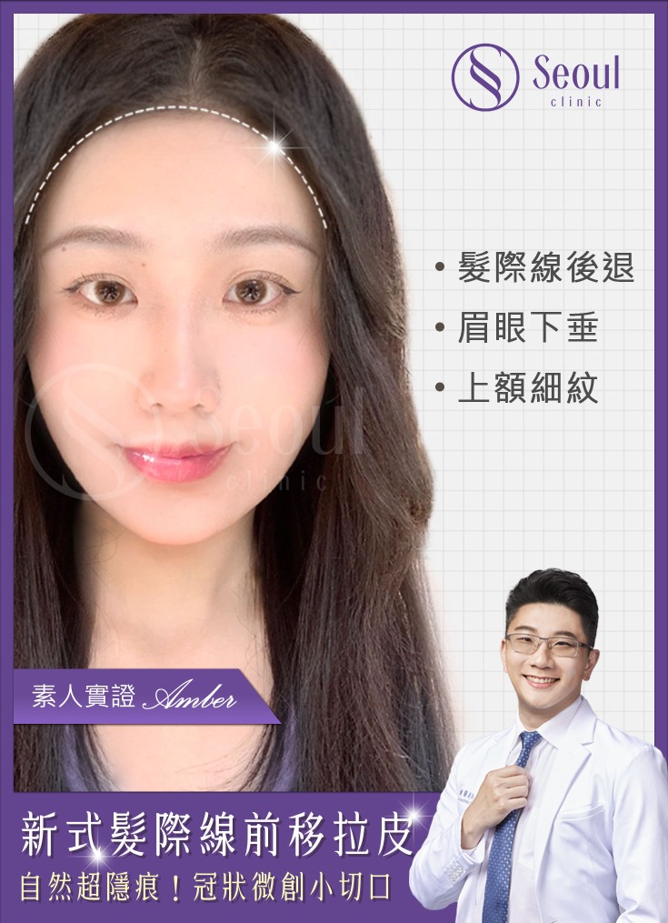 髮際線拉皮-新式髮際線前移拉皮案例分析-首爾醫美