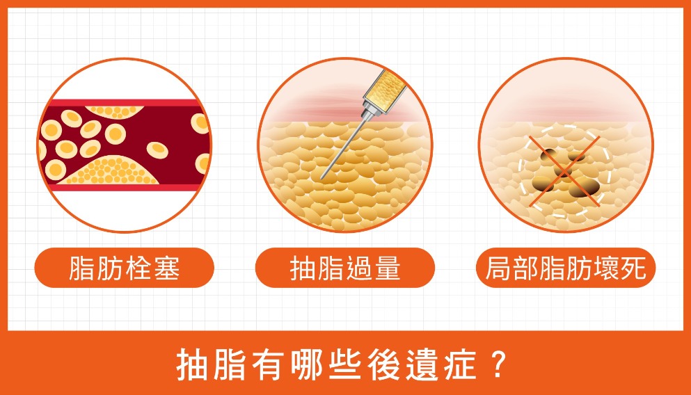 抽脂-抽脂有哪些後遺症？-首爾醫美