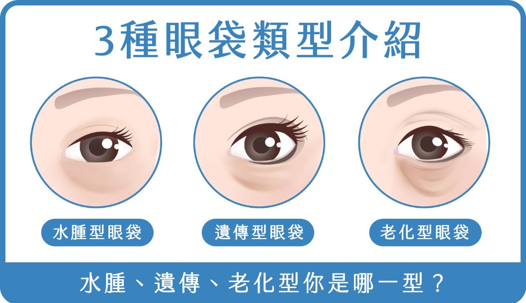 眼袋-3種眼袋類型介紹-首爾醫美