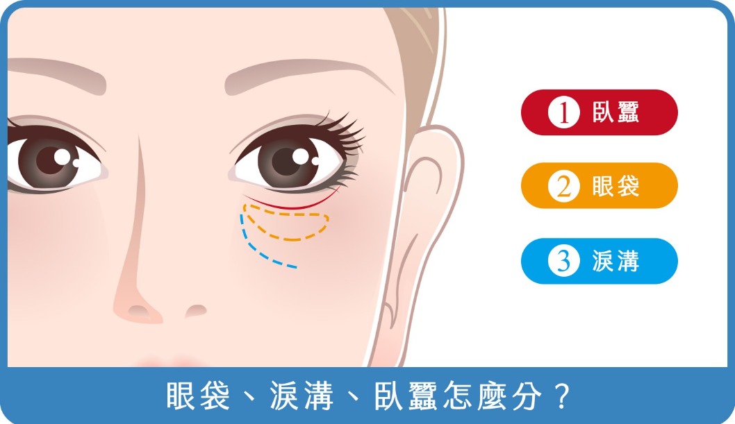眼袋-眼袋、淚溝、臥蠶怎麼分？-首爾醫美