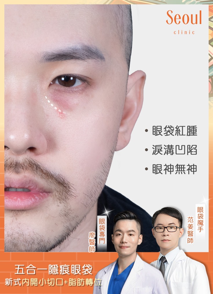 五合一眼袋手術-眼袋紅腫加上淚溝，視覺上精神不佳-首爾醫美診所