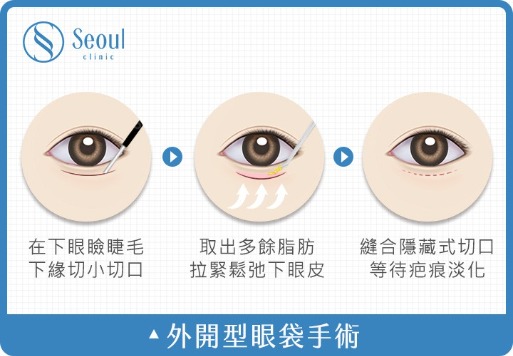 眼袋_外開型眼袋手術_首爾醫美診所