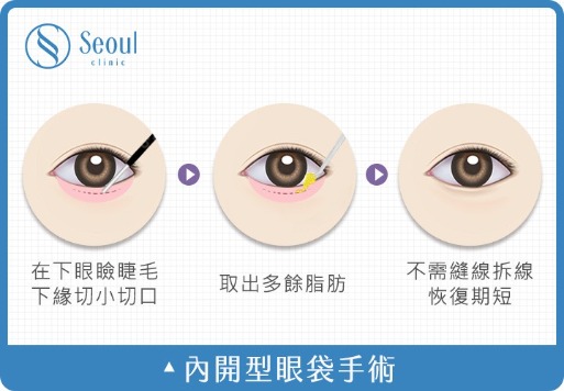 眼袋_內開型眼袋手術_首爾醫美診所