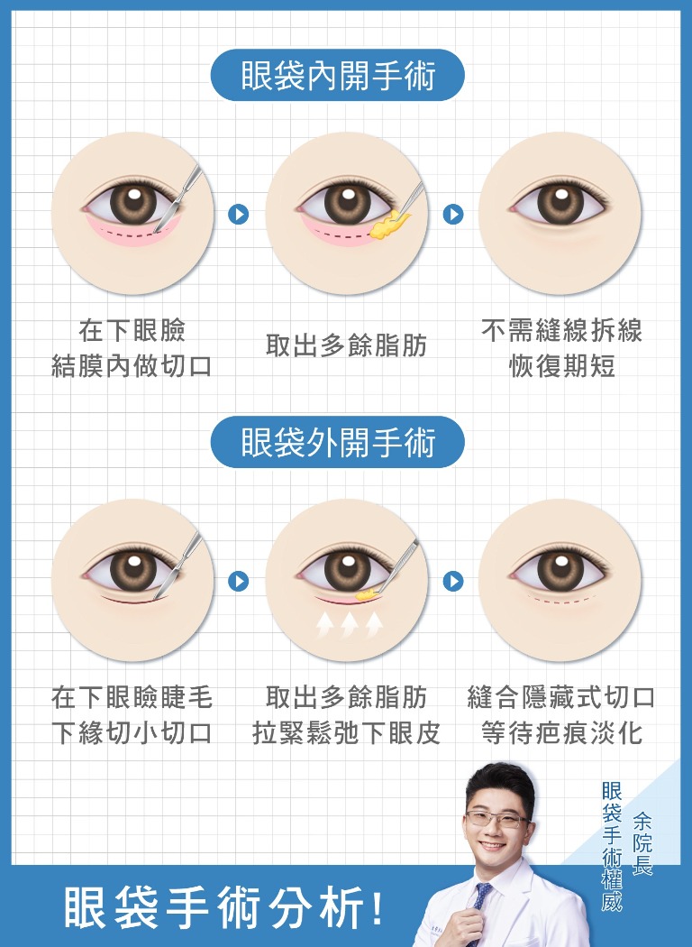 眼袋消除-中度眼袋、脂肪型眼袋-眼袋手術-首爾醫美診所