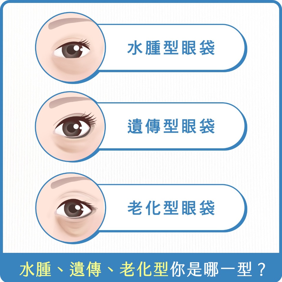 眼袋-3種眼袋類型介紹-首爾醫美