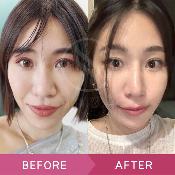 首爾醫美雙眼皮手術_素人實證