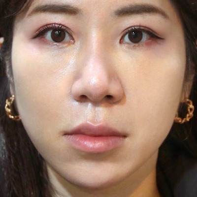 肉毒-肉毒咀嚼肌術後一個月-首爾醫美