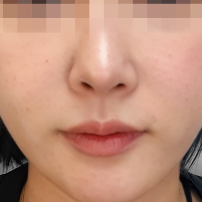 肉毒-肉毒魚尾紋術後一個月-首爾醫美