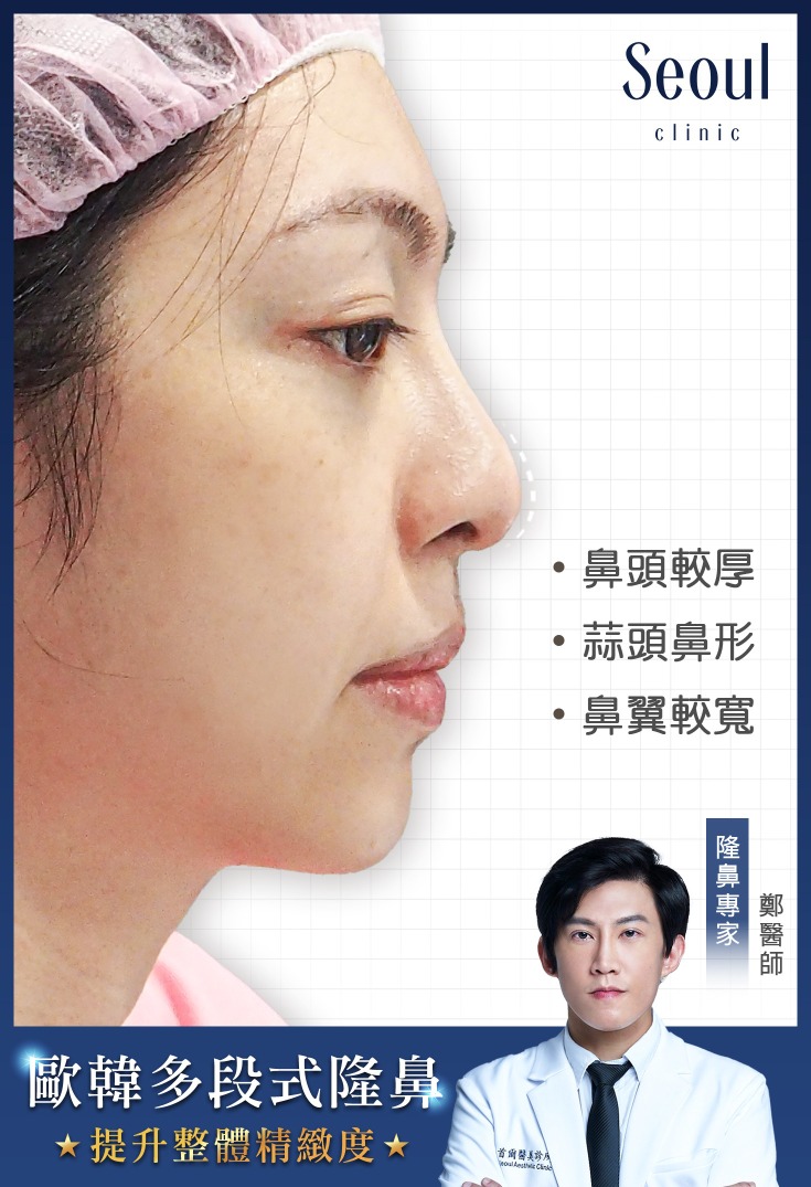 五合一隱痕眼袋手術-眼袋紅腫，加上淚溝，疲憊感倍增-首爾醫美診所