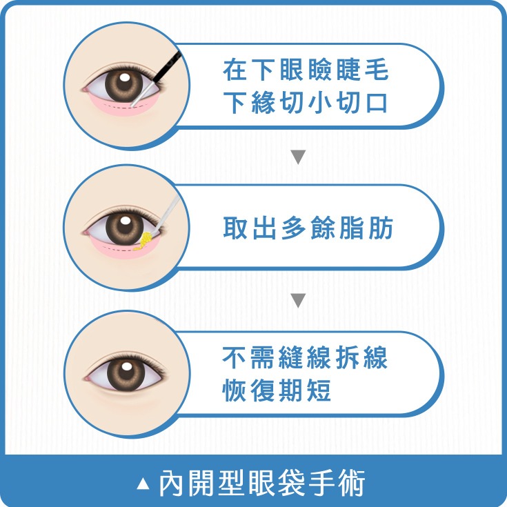 眼袋_內開型眼袋手術_首爾醫美診所
