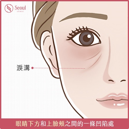 淚溝-淚溝是什麼？-首爾醫美