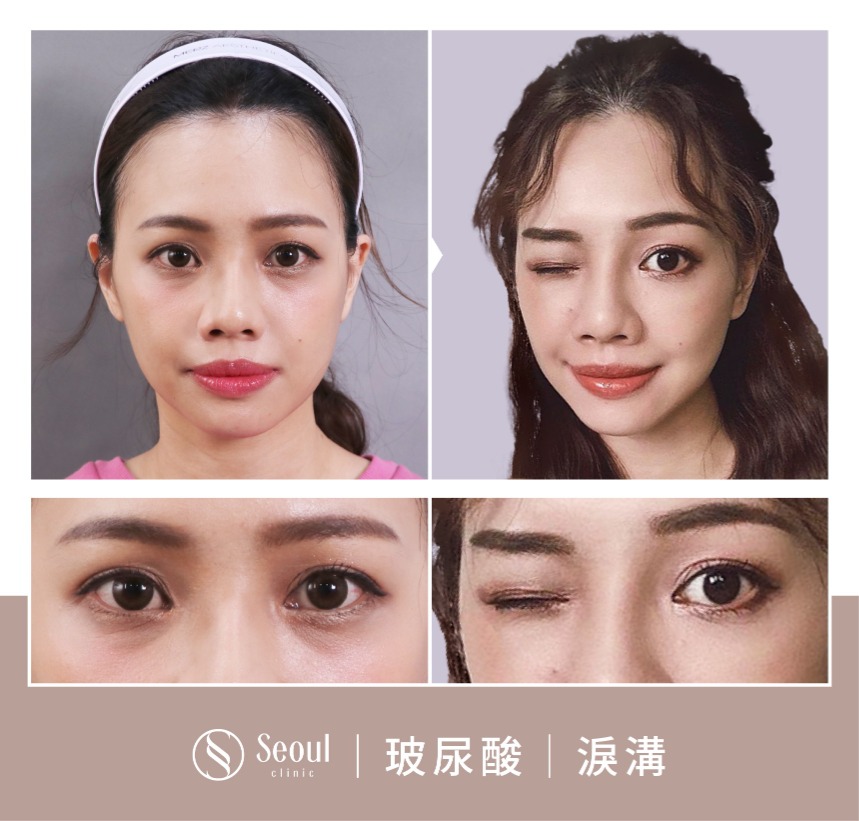 玻尿酸注射-玻尿酸淚溝案例BA2-首爾醫美診所