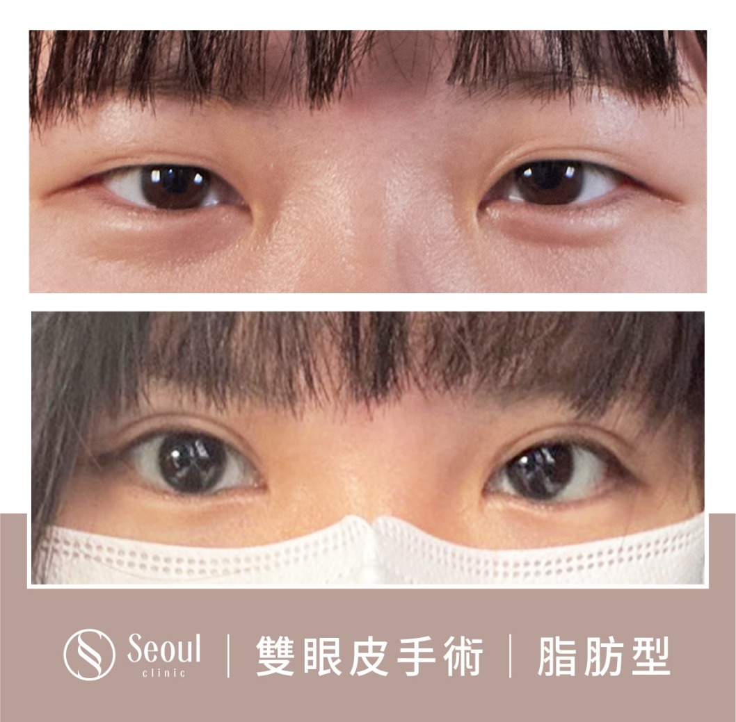 脂肪型雙眼皮-雙眼皮手術案例3-首爾醫美診所