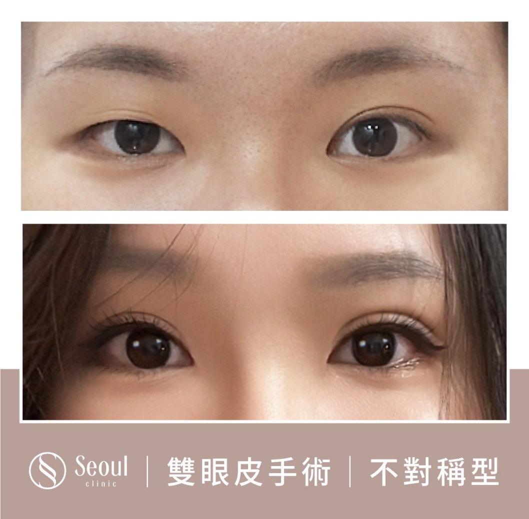 不對稱雙眼皮-雙眼皮手術案例2-首爾醫美診所