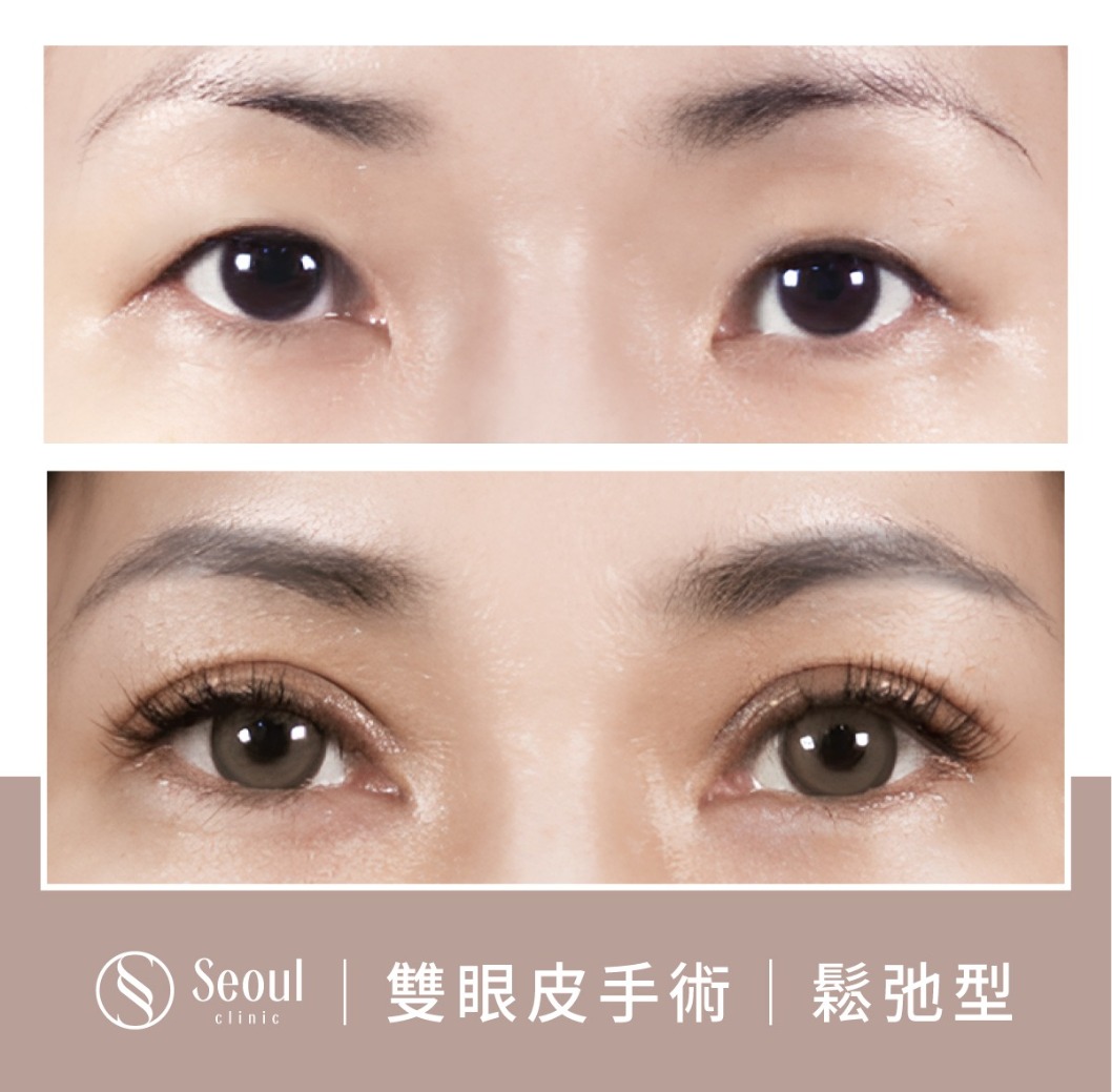 鬆弛型雙眼皮-雙眼皮手術案例1-首爾醫美診所