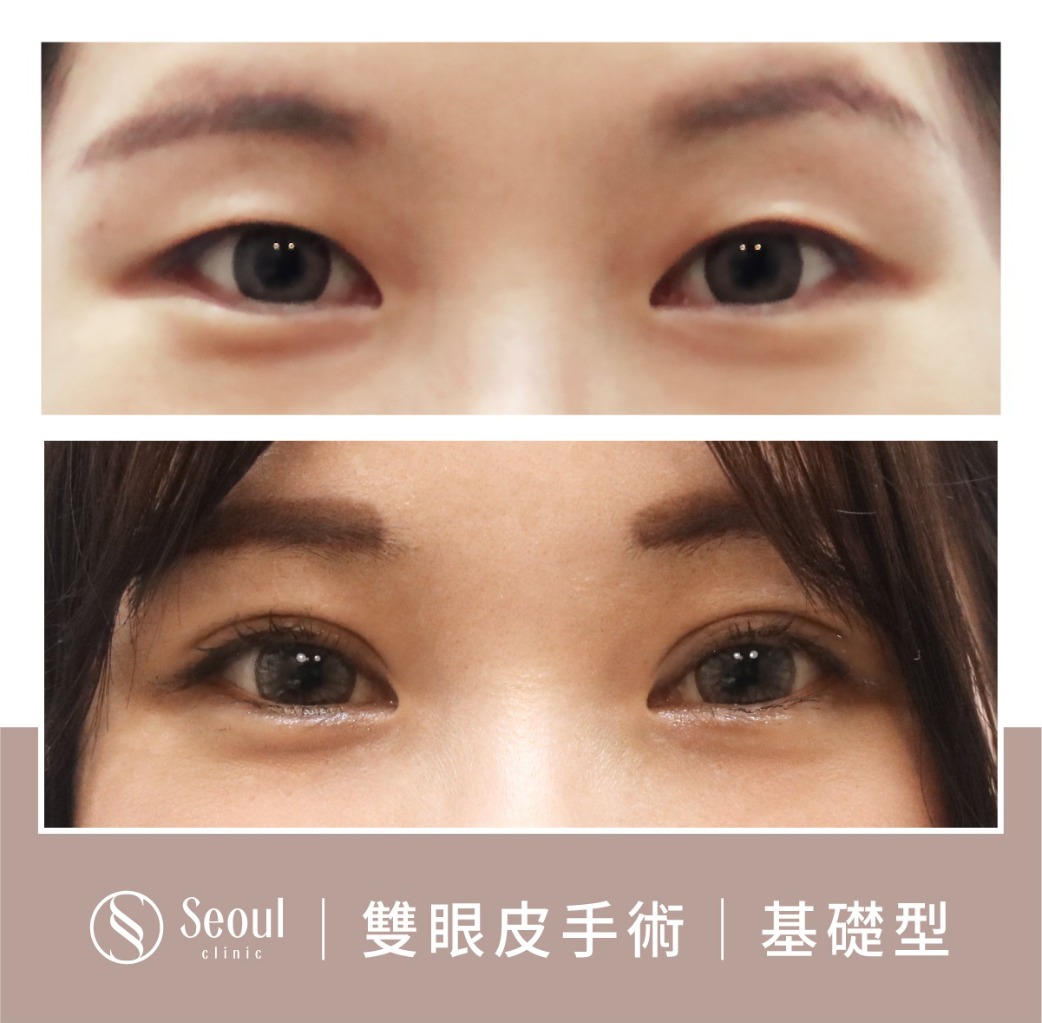 基礎雙眼皮-雙眼皮手術案例2-首爾醫美診所