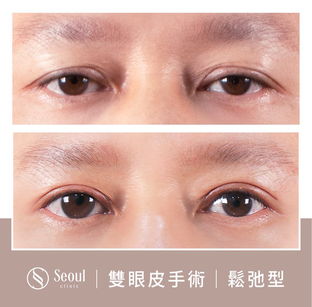 鬆弛型雙眼皮-雙眼皮手術案例3-首爾醫美診所