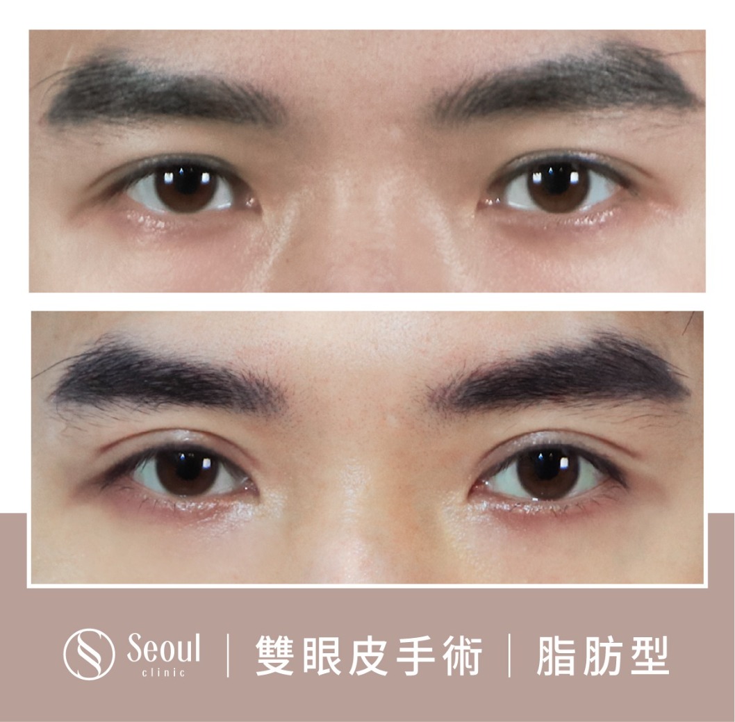 脂肪型雙眼皮-雙眼皮手術案例4-首爾醫美診所