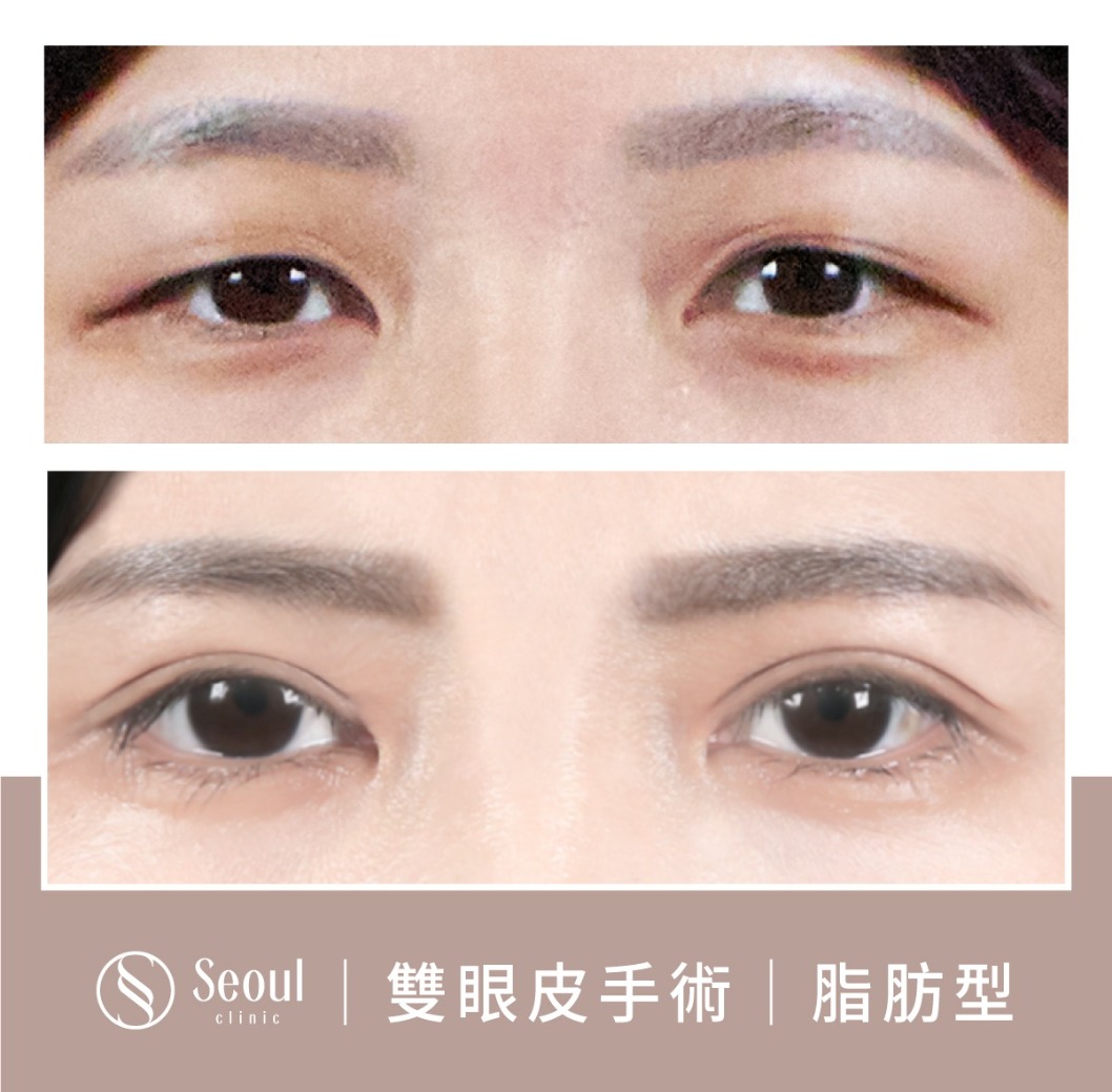 脂肪型雙眼皮-雙眼皮手術案例2-首爾醫美診所