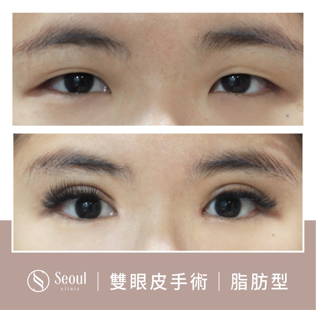 脂肪型雙眼皮-雙眼皮手術案例1-首爾醫美診所