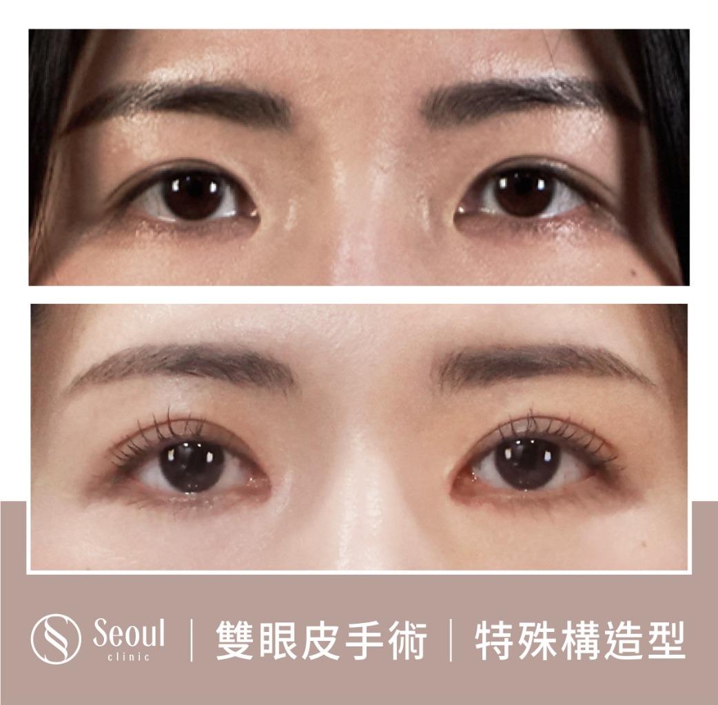 特殊構造型雙眼皮-雙眼皮手術案例1-首爾醫美診所