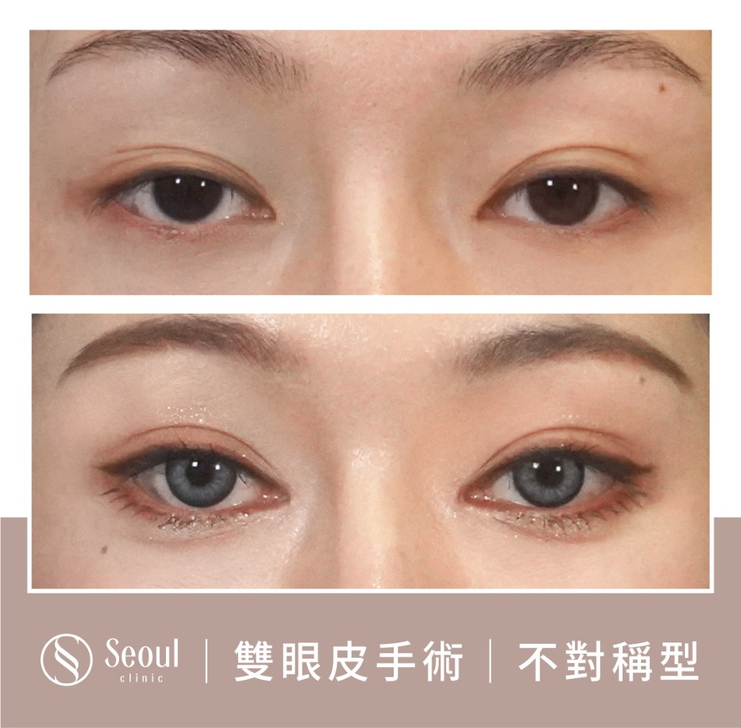 不對稱雙眼皮-雙眼皮手術案例1-首爾醫美診所
