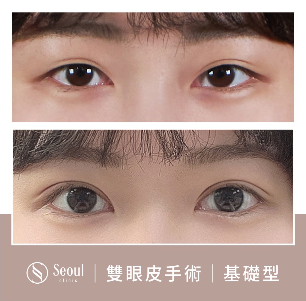 基礎雙眼皮-雙眼皮手術案例3-首爾醫美診所