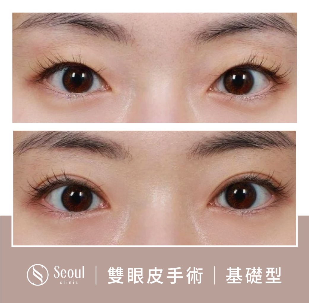 基礎雙眼皮-雙眼皮手術案例1-首爾醫美診所