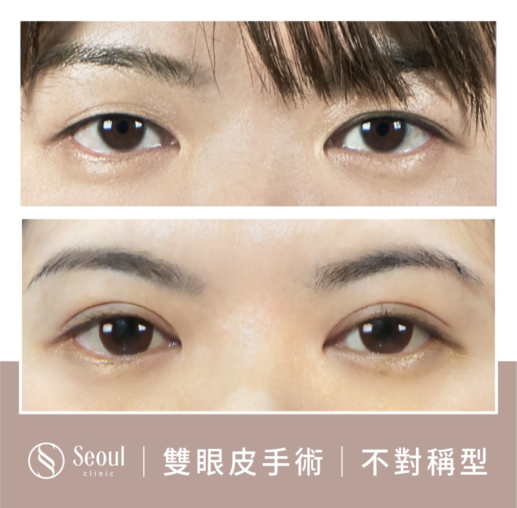 不對稱雙眼皮-雙眼皮手術案例3-首爾醫美診所