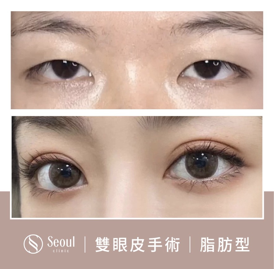 脂肪型雙眼皮-雙眼皮手術案例5-首爾醫美診所