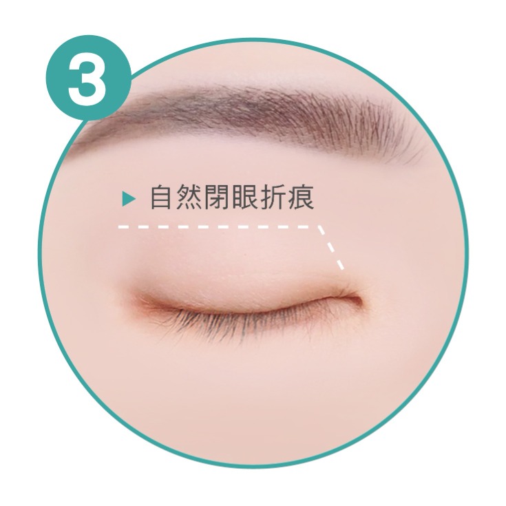 雙眼皮手術_自然閉眼折痕_首爾醫美