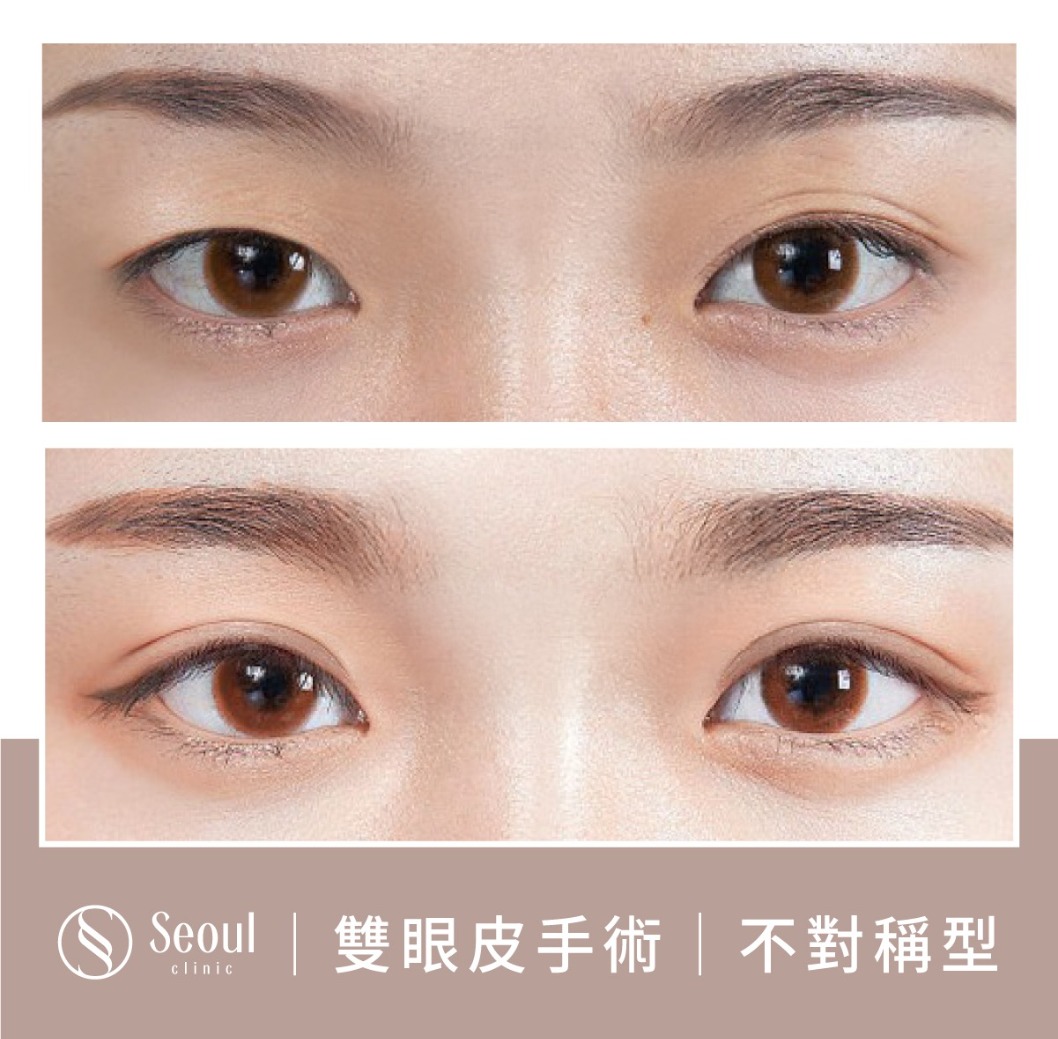 不對稱雙眼皮-雙眼皮手術案例4-首爾醫美診所