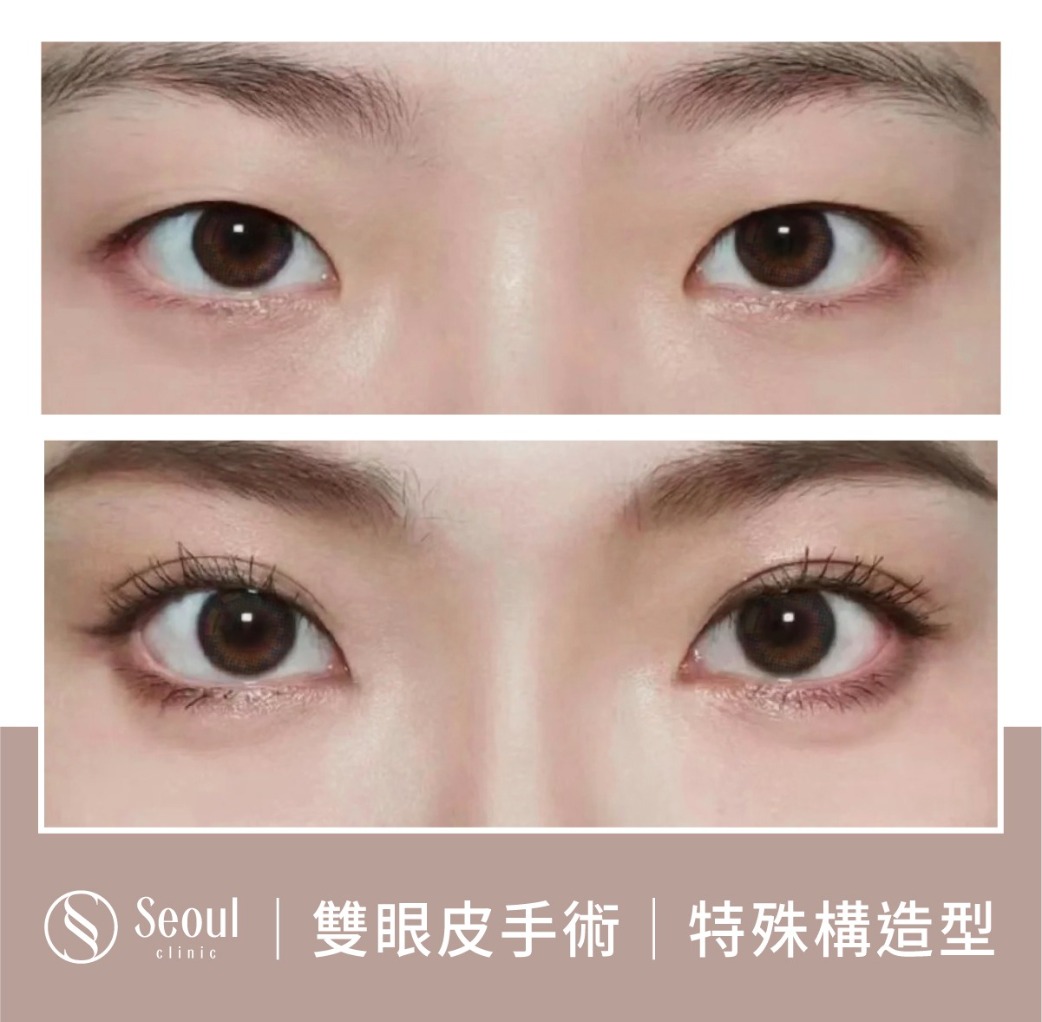 特殊構造型雙眼皮-雙眼皮手術案例1-首爾醫美診所
