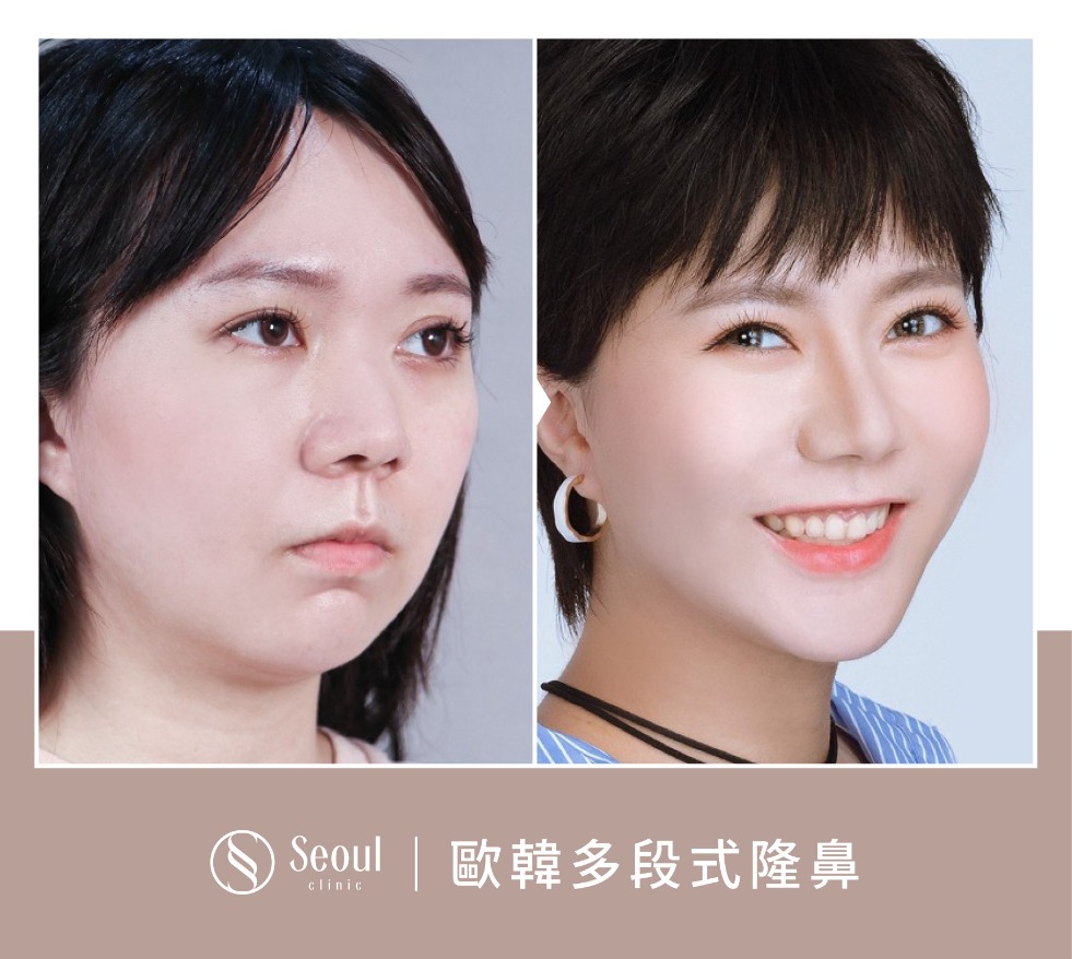 隆鼻手術-歐韓多段式隆鼻案例2-首爾醫美診所