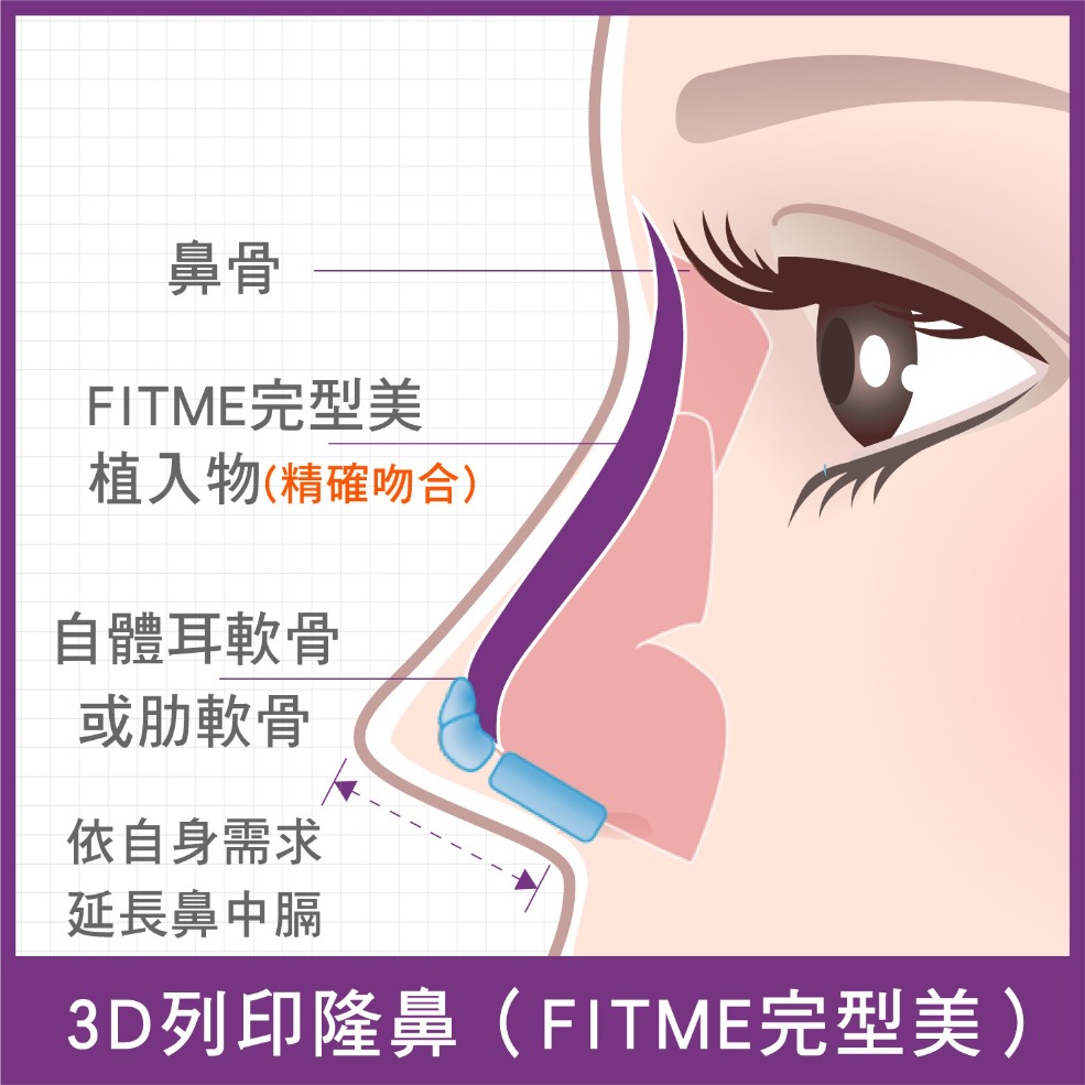 3D列印隆鼻-FITME完形美剖面圖圖解-首爾醫美診所 3D列印隆鼻-FITME完形美剖面圖圖解-首爾醫美診所