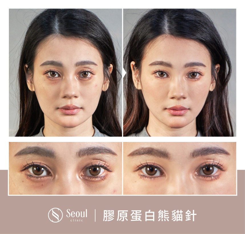 熊貓針-膠原蛋白熊貓針案例分享-首爾醫美診所