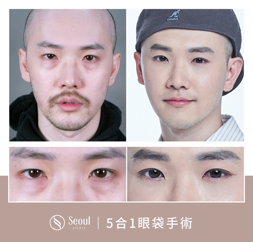 5合一眼袋手術分享-術前浮腫眼袋 → 眼袋內開+補脂手術後半年-首爾醫美診所