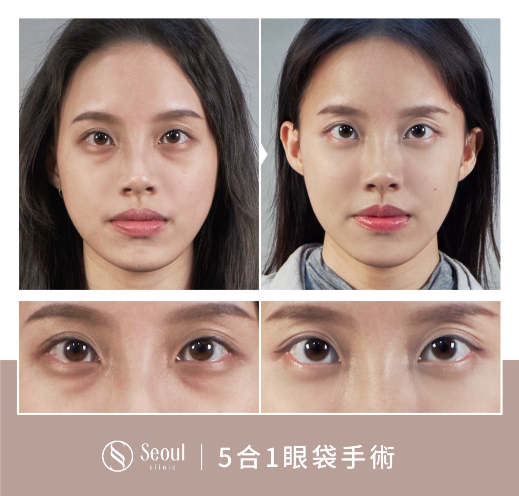 5合一眼袋手術分享-術前結構式眼袋黑眼圈 → 眼袋內開三個月-首爾醫美診所