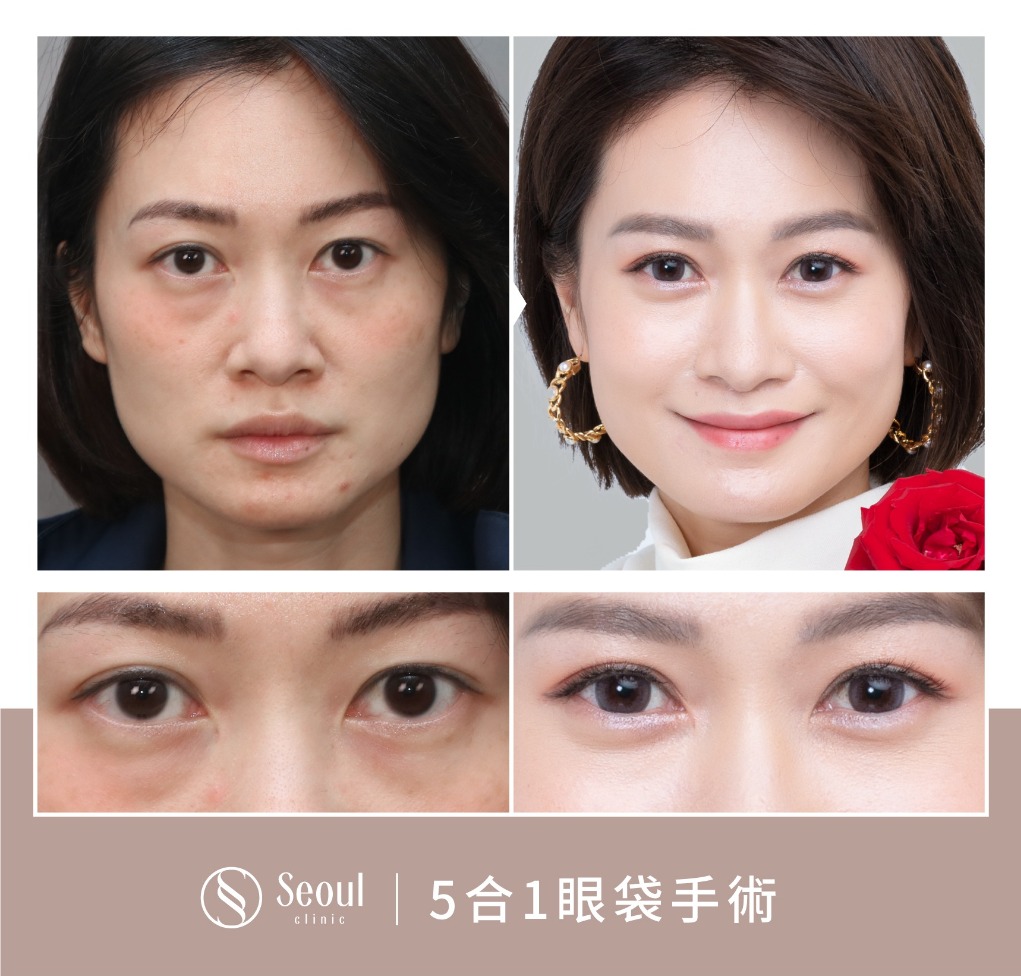 5合一眼袋手術分享-術前疲勞無神的眼袋 → 眼袋內開+蘋果肌補脂三個月-首爾醫美診所
